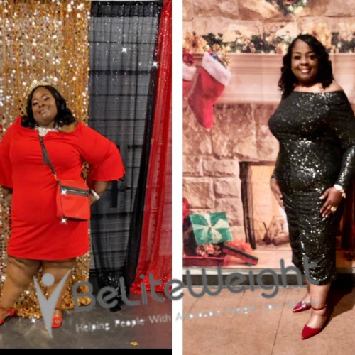 Kemi L - 2 Year After Gastric Sleeve